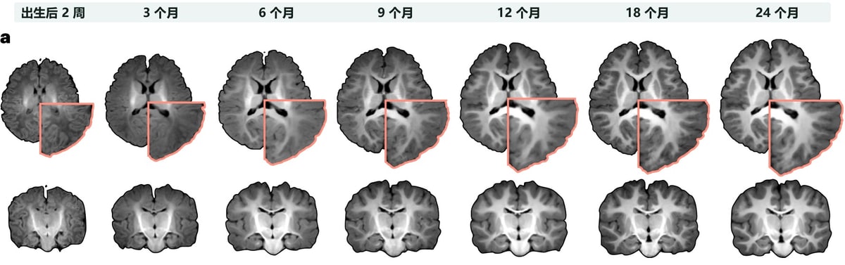发育正常婴儿的大脑磁共振图谱,自左至右为出生后 2 周、3、6、9、12、18、24 个月,上排为横断面、下排为冠状面,脑的体积逐步增大