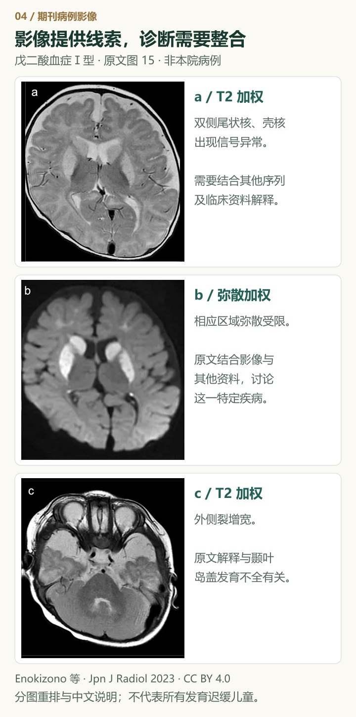 已发表病例中的三幅脑 MRI：a 为 T2 加权图，b 为弥散加权图，显示双侧尾状核与壳核异常；c 为另一层面的 T2 加权图，显示外侧裂增宽；原图分图标记保持不变