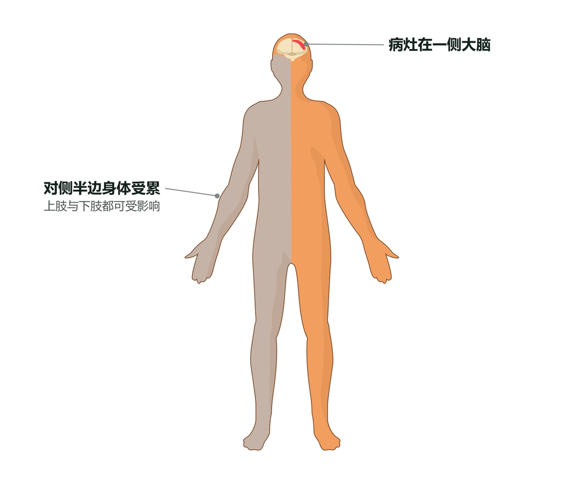 偏瘫示意图:人体正面剪影,一侧大脑标有病灶,对侧半边身体以灰色标出