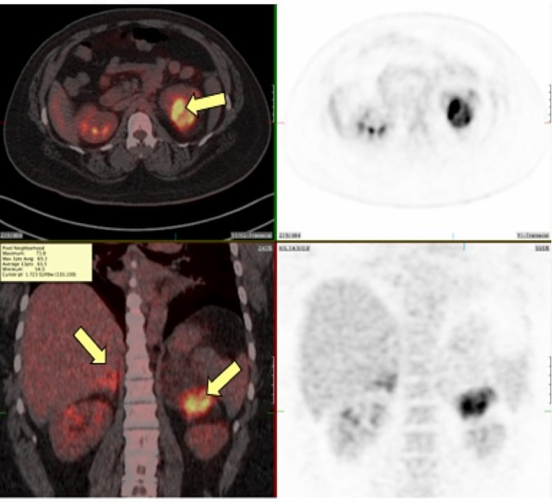 21-羟化酶缺乏症患者的 CT 影像:双侧肾上腺明显增大