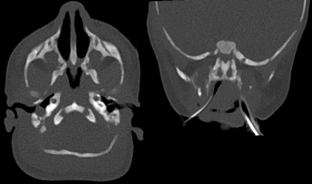 新生儿双侧后鼻孔闭锁的 CT 影像,轴位与冠状位:鼻腔后端被膜性结构封闭